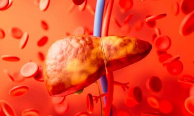 Esteatose hepática e canabinóides